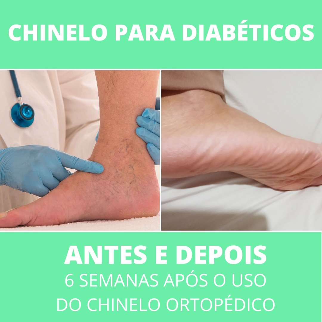 Chinelo Masculino para Diabéticos - Frete Grátis